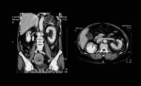 ct scan abdomen
