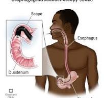 egd endoscopy