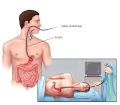 endoscopy procedure