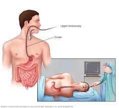 gastritis endoscopy
