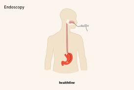 gerd endoscopy