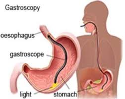 ogd endoscopy